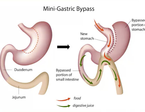 mini bypass gastrico
